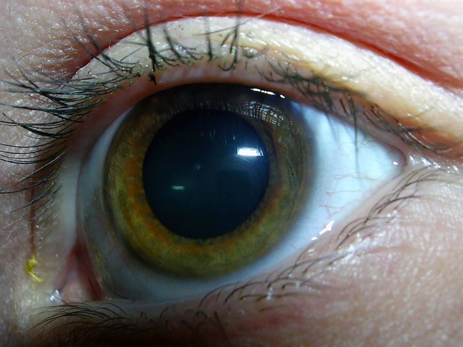 Glaucoma - Visión Excelente